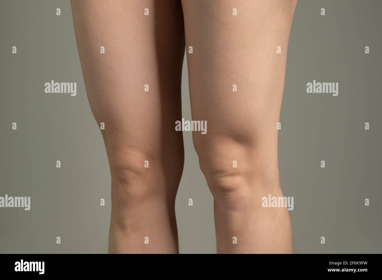 Fat folds above knees. Woman`s hips closeup raw studio shot in grey background. Dieting and fat loss concept. Stock Photo